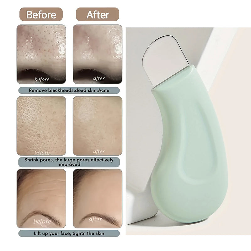 Ferramenta de remoção de cravos faciais, limpeza profunda do nariz, remoção de acne, ferramenta portátil de cuidados de beleza, ferramenta auxiliar de cuidados com a pele